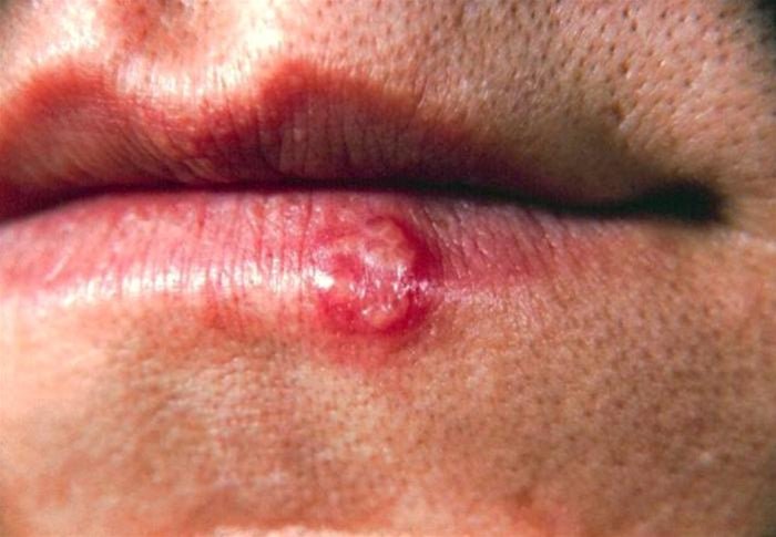 Behandling af herpes: herpes i munden, forkølelsessår og herpes genitalis - Nordic Tests ApS